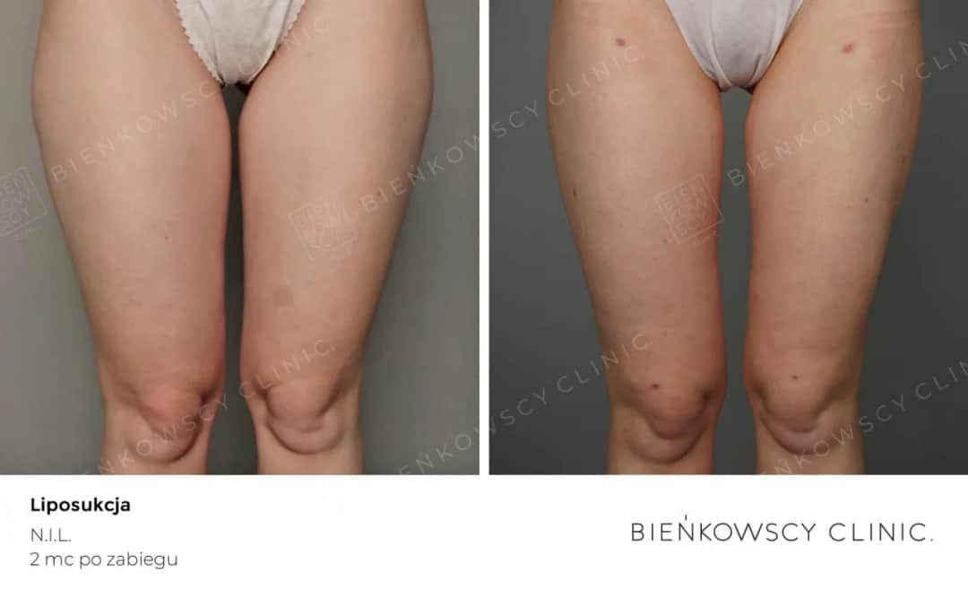 Liposukcja: modelowanie sylwetki czy odchudzanie? Sprawdź, co musisz wiedzieć